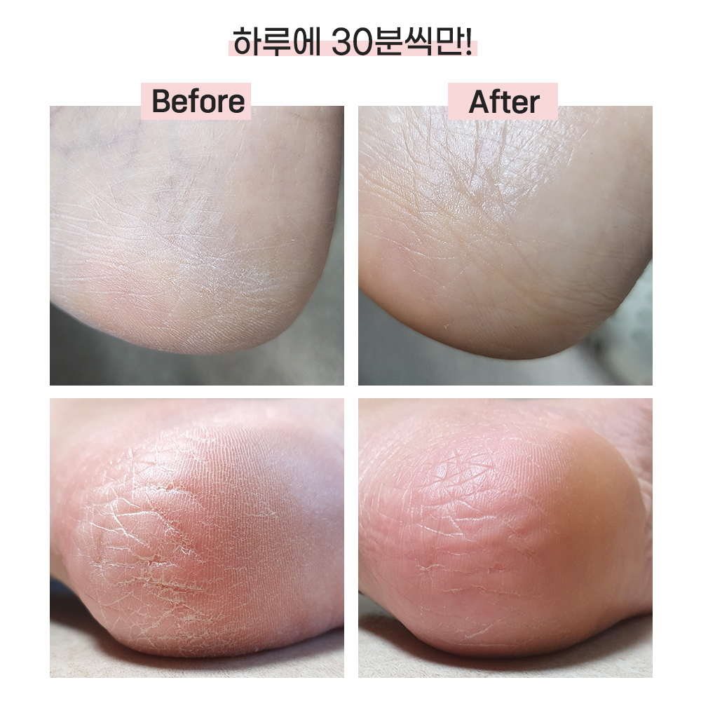 곰피트 1+1 실리콘 앞트임 풋각질케어 발 뒤꿈치 보습양말 이미지 6