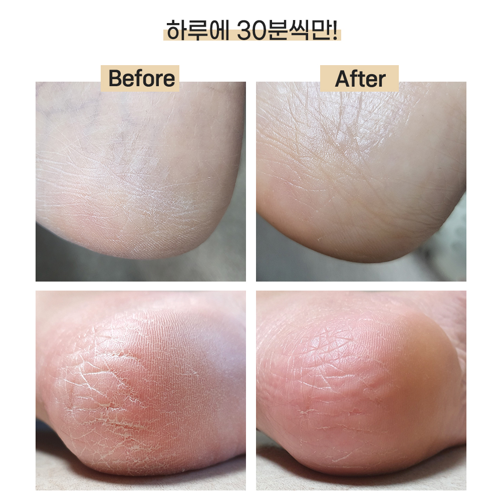 곰피트 1+1 발 뒤꿈치 각질관리 실리콘 보습양말 - 상세 이미지 4