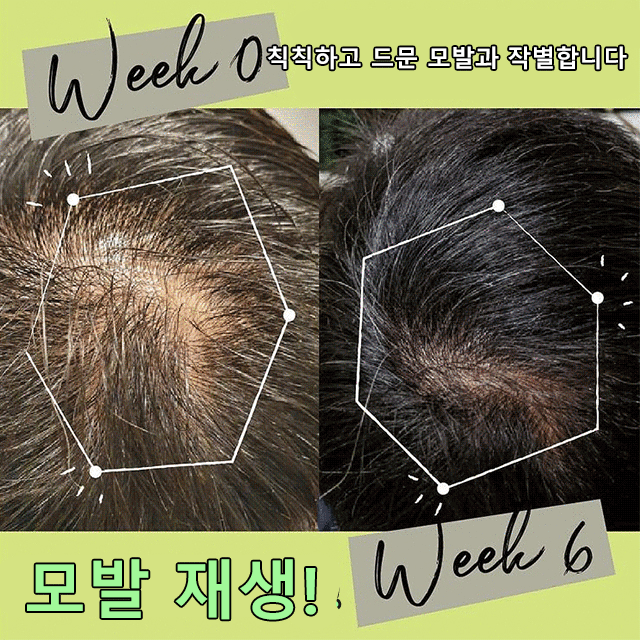 탈모 방지 및 발모 헤어 스크럽제 거스러기 제거 가려움증 완화 두피스크럽 : 컬러풀 타운