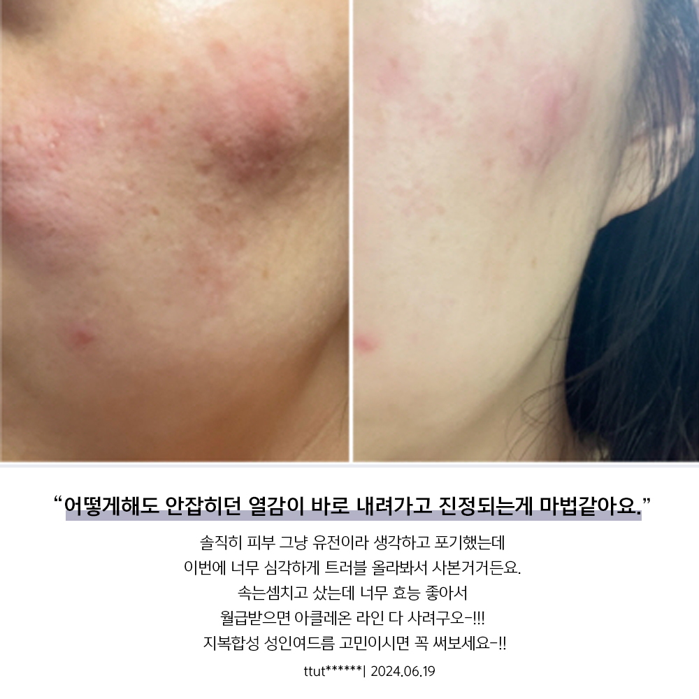 아클레온 화농성 좁쌀 성인 청소년 여드름 화장품 2종 (앰플+스팟) 이미지 6