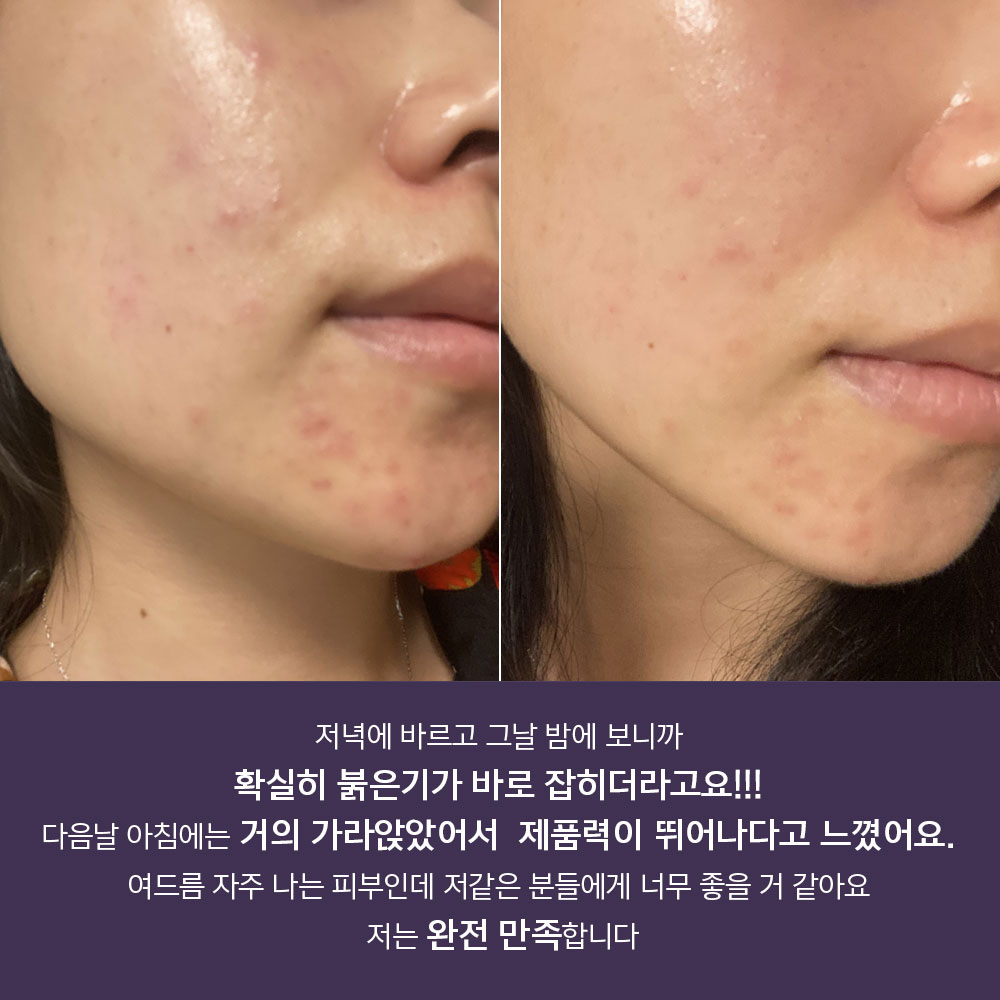 아클레온 센텔라드레싱파우더 티트리 염증 여드름 스팟 젤 30ml 여드름 빨간 붉은 자국 이미지 8