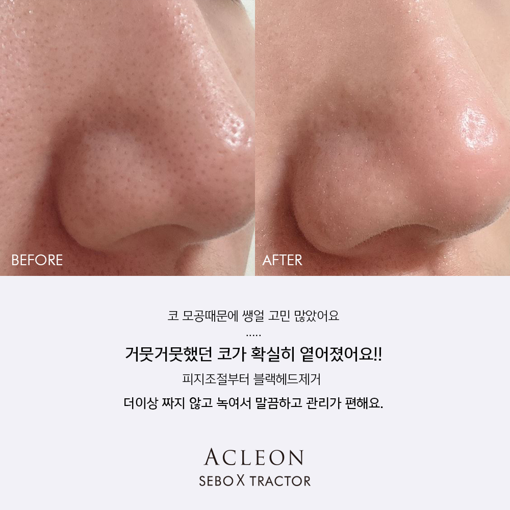 아클레온 피지과다 블랙헤드 화이트헤드 얼굴 피지 제거 관리 3종세트 - 상세 이미지 5