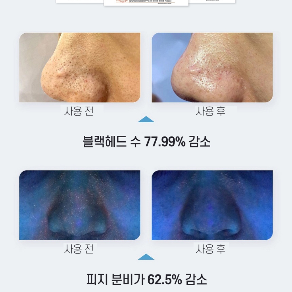 피지 불리기 온열 피지 제거기 블랙헤드 압출 아쿠아필 노폐물 클렌저 - 상세 이미지 3