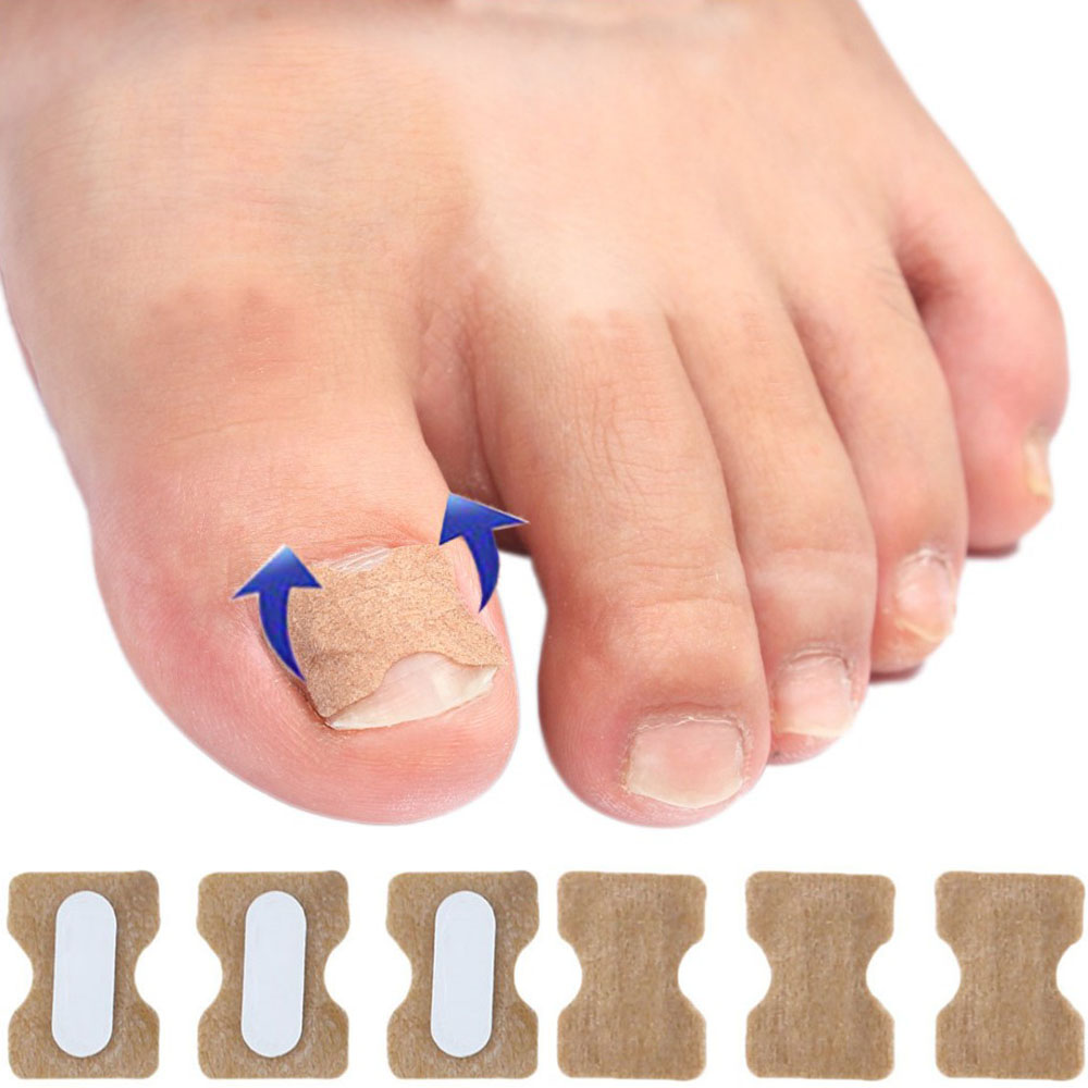 50개입 탄력 발톱밴드 파고드는 발톱 테이프 핀처 휜 문제성발톱 고정기 와이어 팁