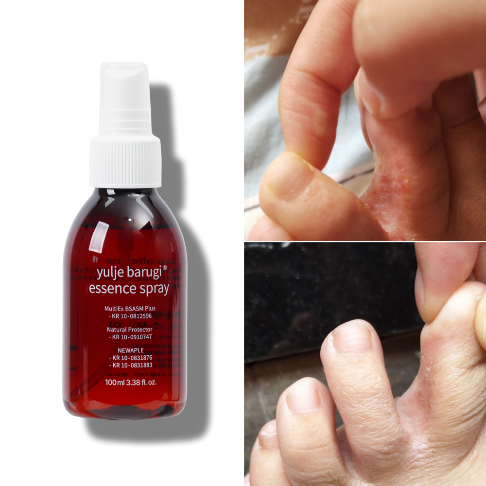 율제 바루기 무좀 풋 스프레이 손톱 발바닥 각질 발톱 손습진 제품 이미지