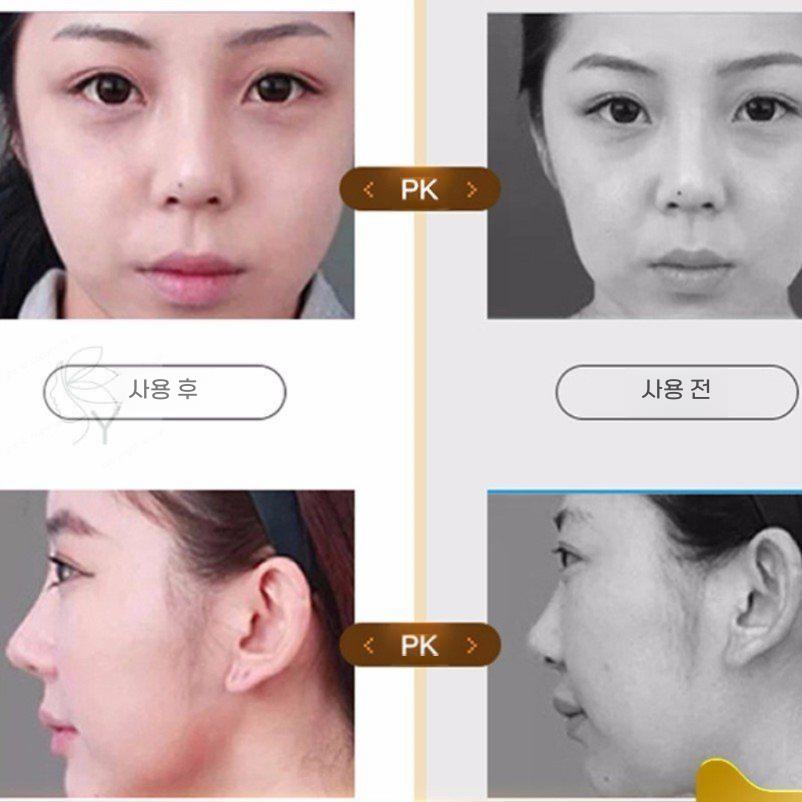 코뽕 코 슬림 클립 교정기 브리지 오똑 키트 콧대 코끝 콧볼 - 상세 이미지 4