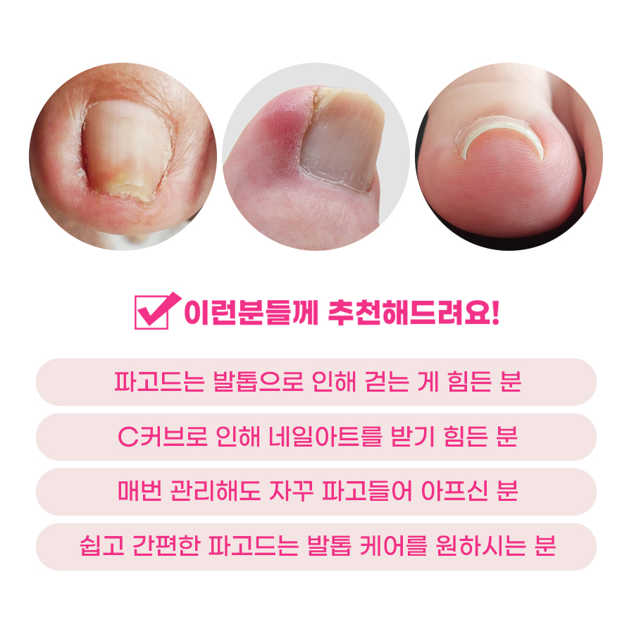 EV36 크랄레 셀프키트 03 파고드는발톱케어세트 발톱테이프 C커브발톱 ingrown - 상세 이미지 2