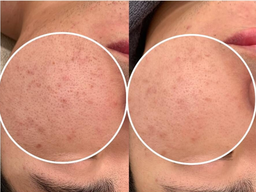 아리더마 해초필링스피큘 PDRN 모공 속건조 색소침착 재생 트러블 각질 2개월 풀세트 - 상세 이미지 5