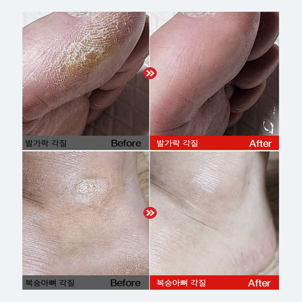 굳은살제거 메디픽미 글라스톤 풋파일 1개,발뒤꿈치 각질제거기 발각질 뒷꿈치 케어 제거돌 이미지 8