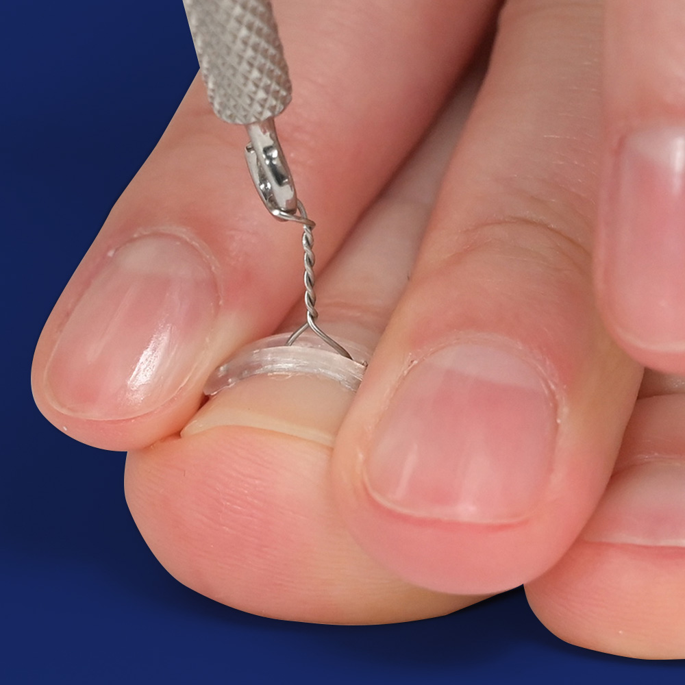 퍼펙토 픽스 내성발톱 교정기 단품 와이어 의료기기 파고드는 발톱 자가치료