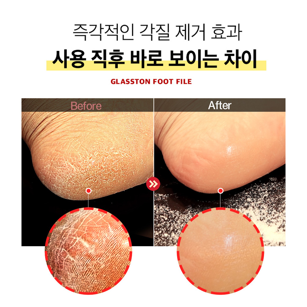 굳은살제거 메디픽미 글라스톤 풋파일 1개,발뒤꿈치 각질제거기 발각질 뒷꿈치 케어 제거돌 - 상세 이미지 3