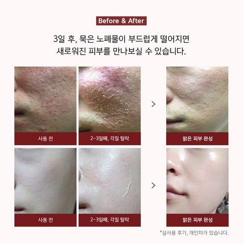 비큐셀 해초필링 새살필 알라딘필링 피부박피 약초필링 3회분 - 상세 이미지 2