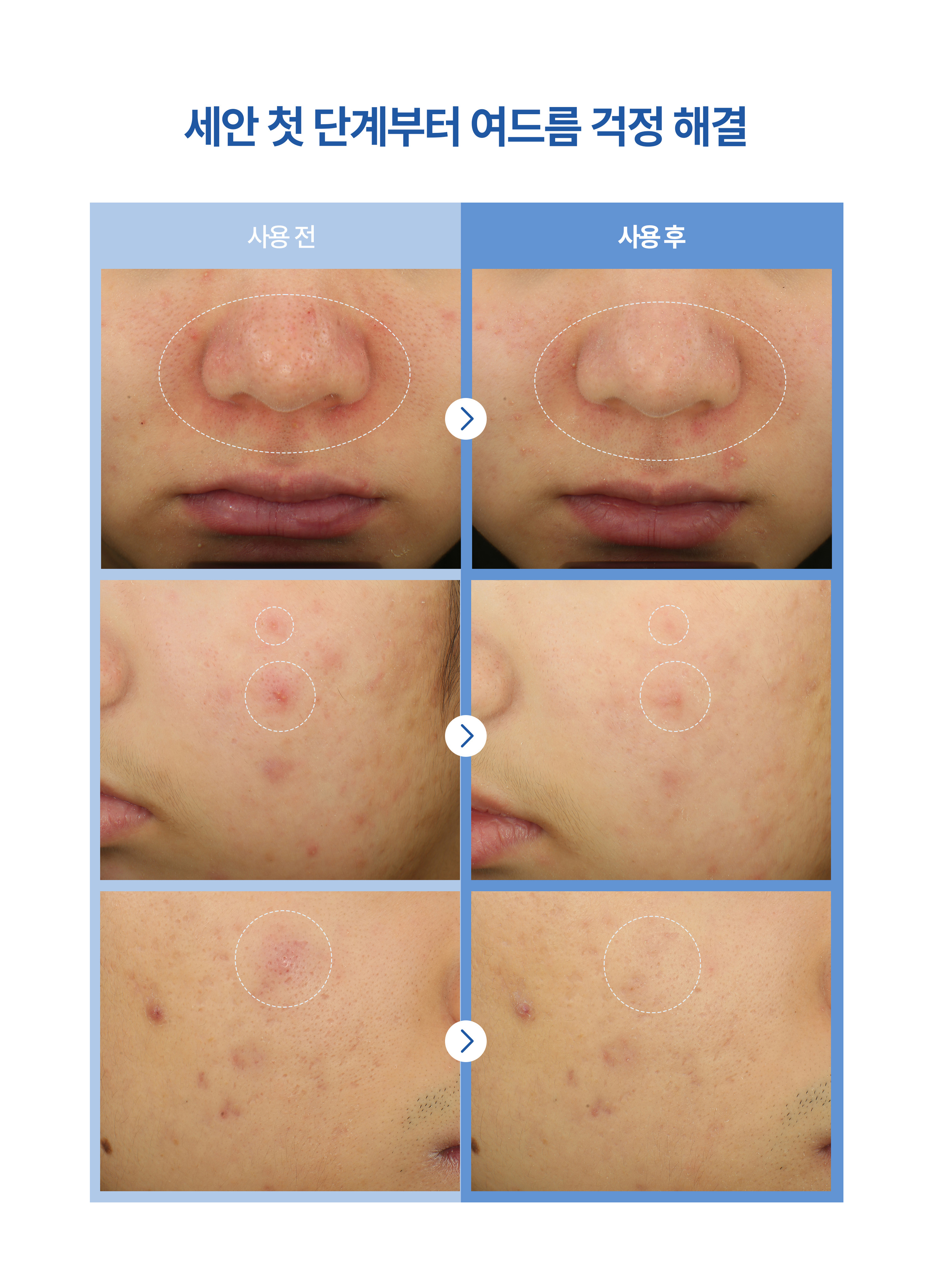 korean cleansing balm phyton squalane blue