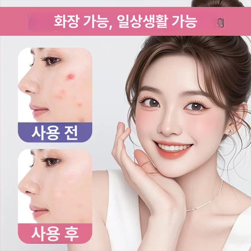 솔비에 별여드름패치 패치 여드름패치 트러블 스틱 레이저스타 해결 - 상세 이미지 5