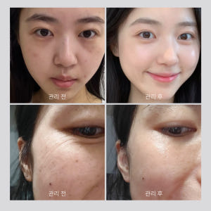 PDRN 앰플 고함량 피디알엔 바이옴 69% 히알루론산 모공 스킨부스터 ... 솔직 후기 | 피부 타입별 분석 - 상품 이미지 3