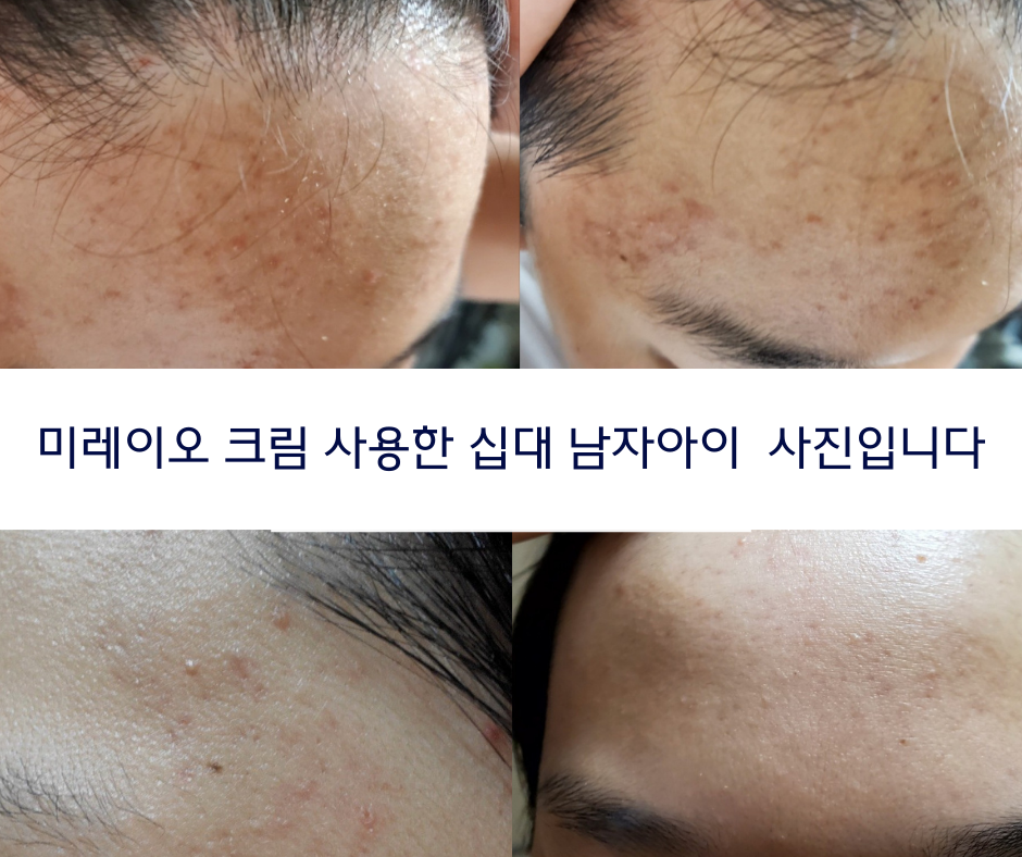 세나수니 미레이오 크림  청소년 여드름케어 ,수분크림, 올인원 수면팩 겸용 순한성분 Mirèio스킨케어 - 상세 이미지 3