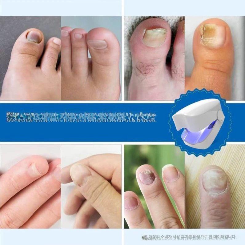 발톱 무좀 레이저 손톱 발관리기 가정용 홈케어 내성 다크블루type-c충전인터페이스 - 상세 이미지 5