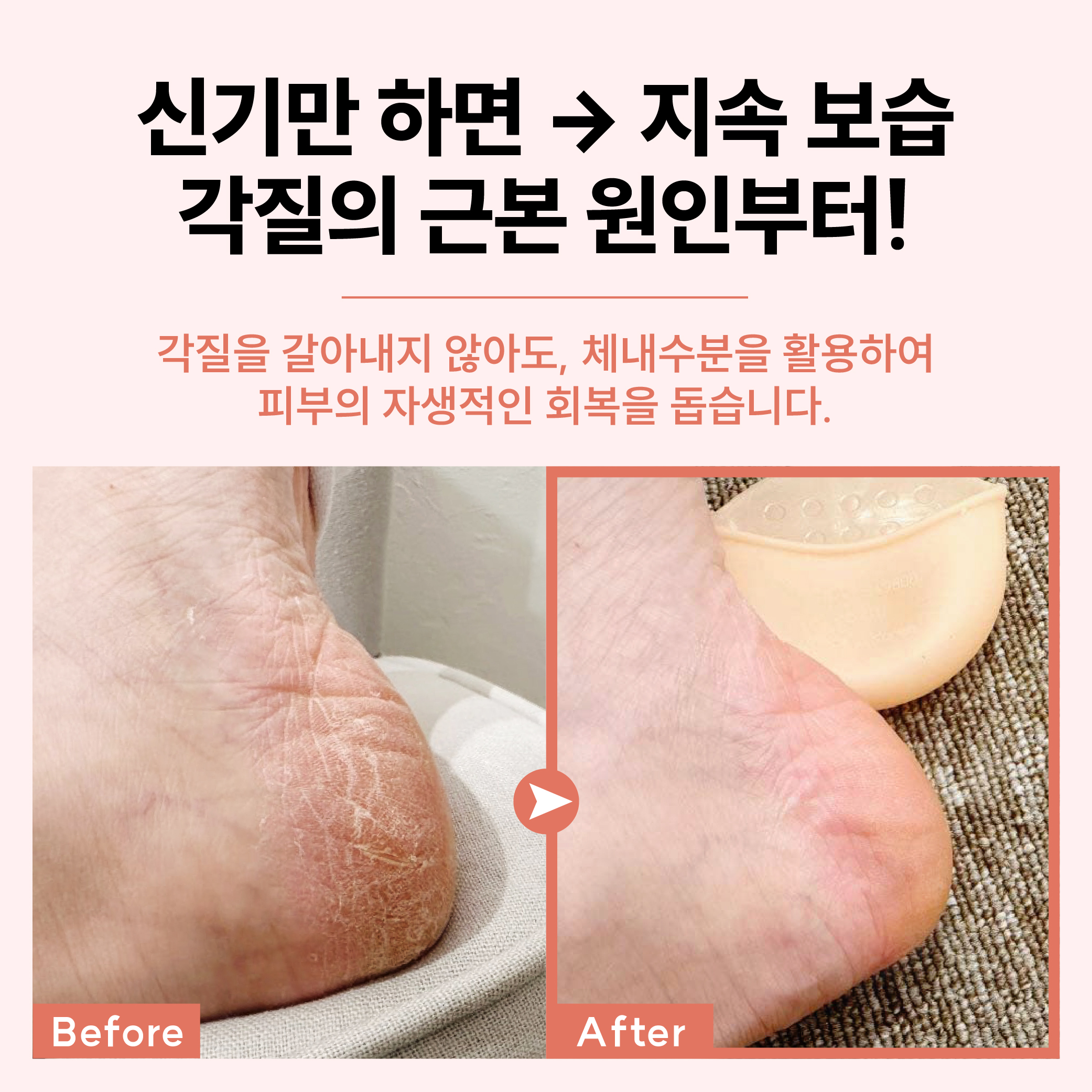 보스비 [스킨힐캡] 단품 실리콘 풋패드 발뒤꿈치 발꿈치 발바닥 통증 갈라짐 N배송 - 상세 이미지 3