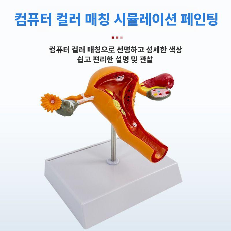산부인과 자궁모형 난소 여성 생식기 구조 교구 해부도 양측 난소 자궁 - 상세 이미지 3