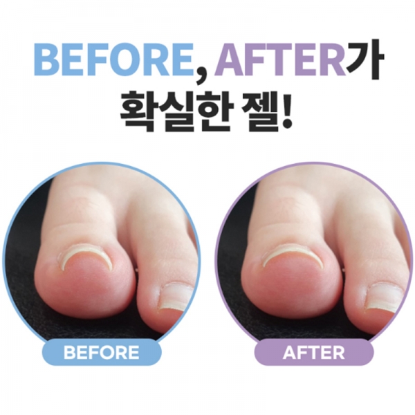 1+1 닥터크랄레젤(플랫젤) 10ml 리커버 (STEP2) - 상세 이미지 2