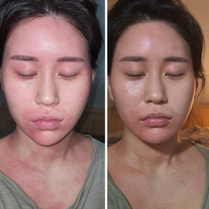 저자극 피부진정 에이디솔루션 아토패스트 카밍패치 & 세럼 - 상세 이미지 2