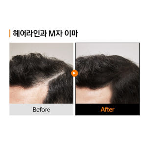 누아레모 두피타투브러쉬 정수리커버 20ml, 1개 솔직 후기 | 피부 타입별 분석 - 상품 이미지 4