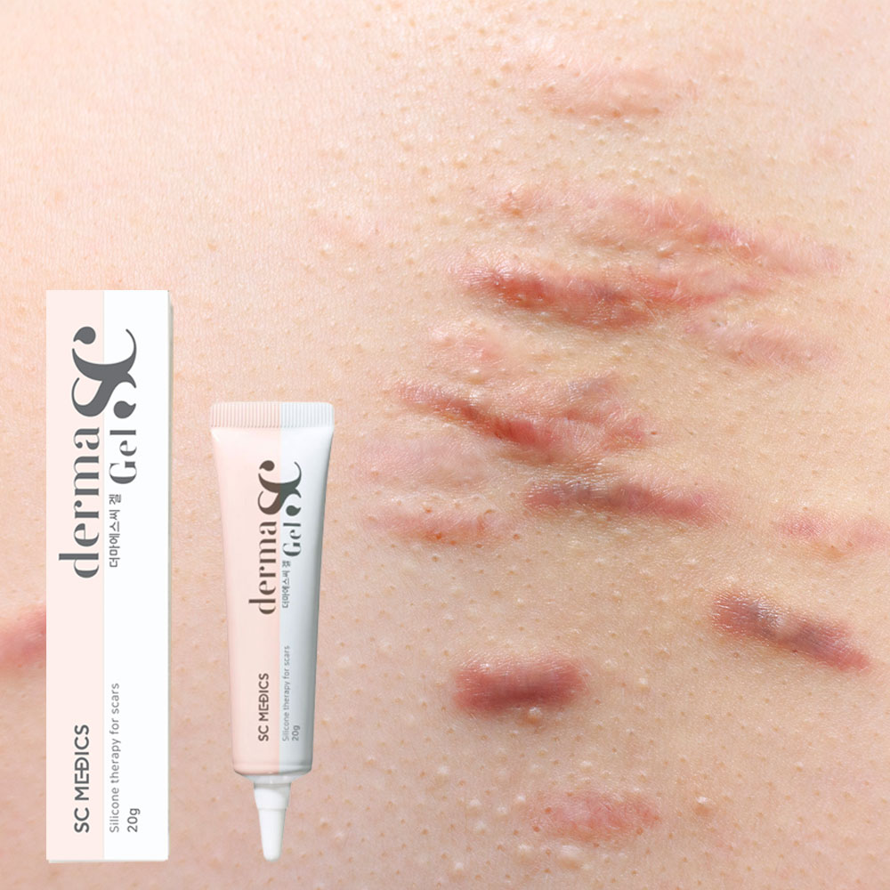 더마에스씨겔 흉터 연고 20g 화상 제왕절개 수술 켈로이드 실밥 여드름 제거 흉지우개