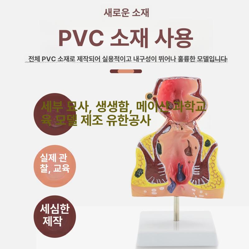 인체 치질 병변 모형 직장 내치질 병리학 항문외과 해부학 1부위 - 상세 이미지 5