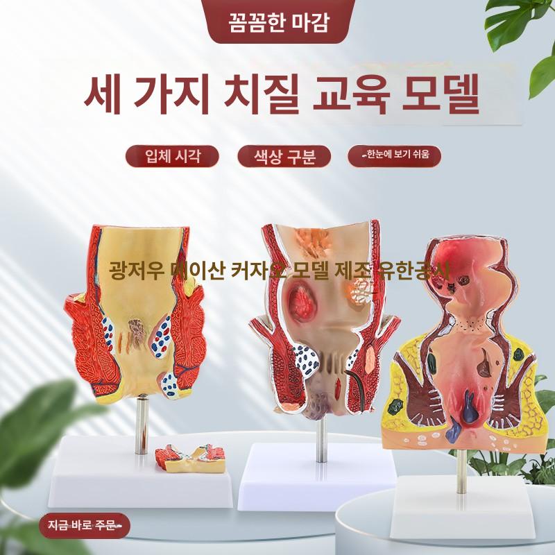 인체 치질 병변 모형 직장 내치질 병리학 항문외과 해부학 1부위 - 상세 이미지 2