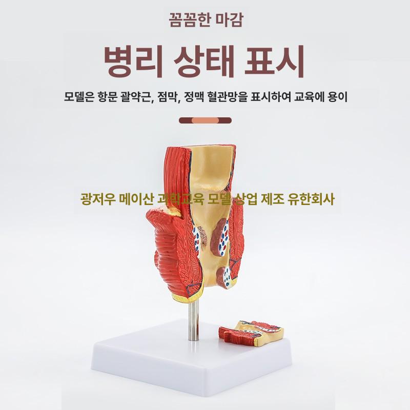 인체 치질 병변 모형 직장 내치질 병리학 항문외과 해부학 1부위 - 상세 이미지 4