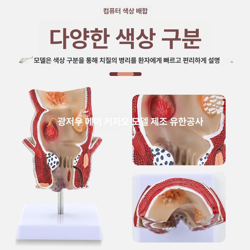 인체 치질 병변 모형 직장 내치질 병리학 항문외과 해부학 1부위 - 상세 이미지 3