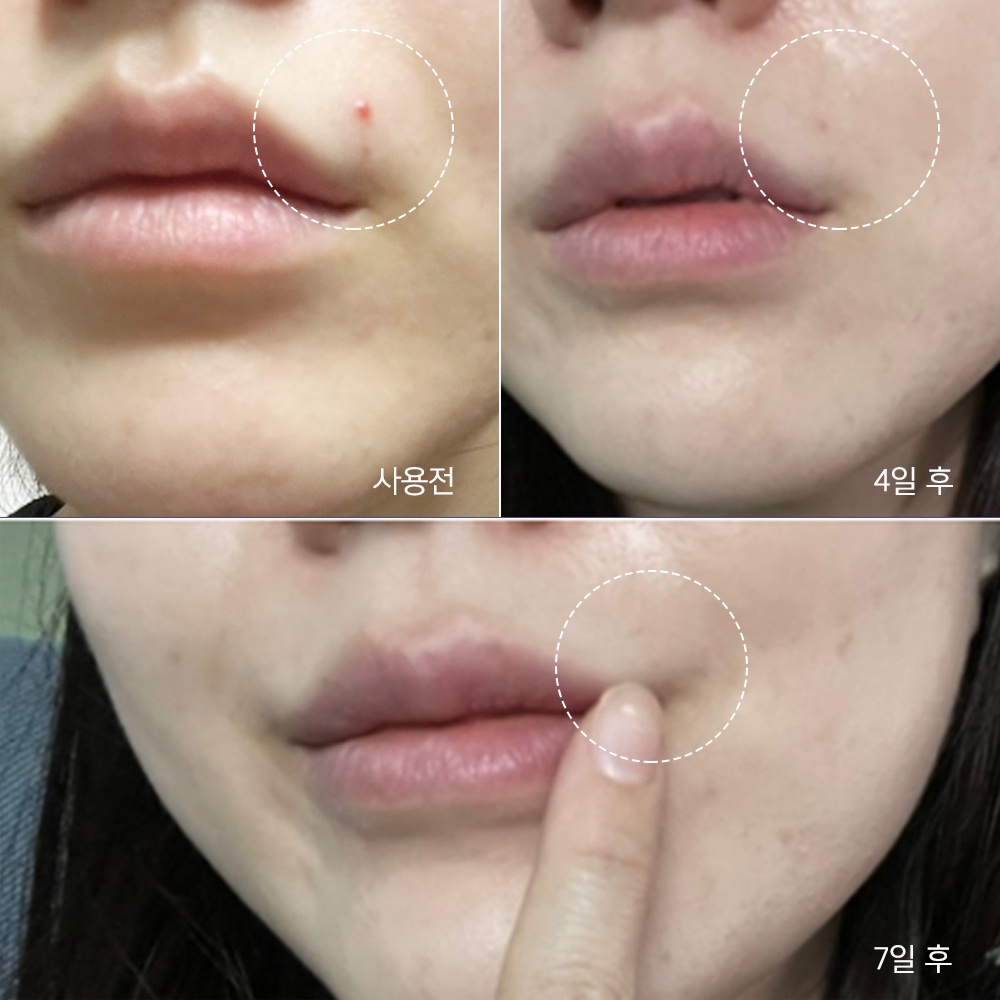 아클레온 병풀 여드름 수부지 피부과 모공 수축 MTS 앰플 15ml 2개 모공줄이는법 이미지 8