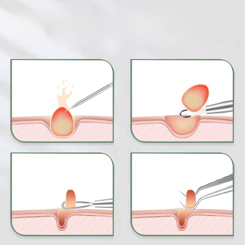초미세 핀포인트 피지 핀셋 여드름 집게 압출기 멀티 짜는도구 뾰루지 코 - 상세 이미지 3