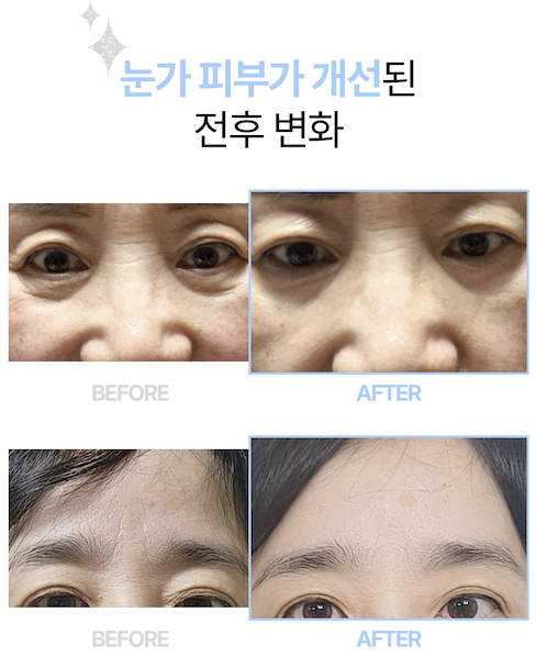 퀸블리 주름케어 마이크로 니들패치(1매 2개입) 2매, 1개 - 상세 이미지 4