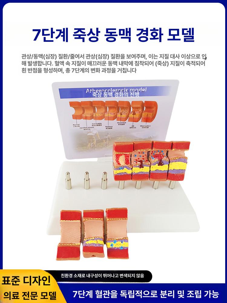 의대 교육용 혈관모형 해부학 보건 동맥 경화 혈전 단일 항목 - 상세 이미지 5