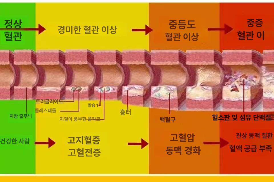 의대 교육용 혈관모형 해부학 보건 동맥 경화 혈전 단일 항목 - 상세 이미지 3