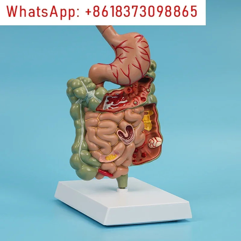병리학적 소화기 모델 디스플레이 교육 설명 대과학