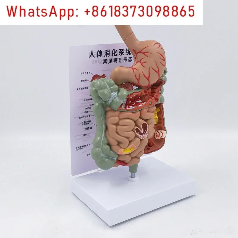 병리학적 소화기 모델 디스플레이 교육 설명 대과학