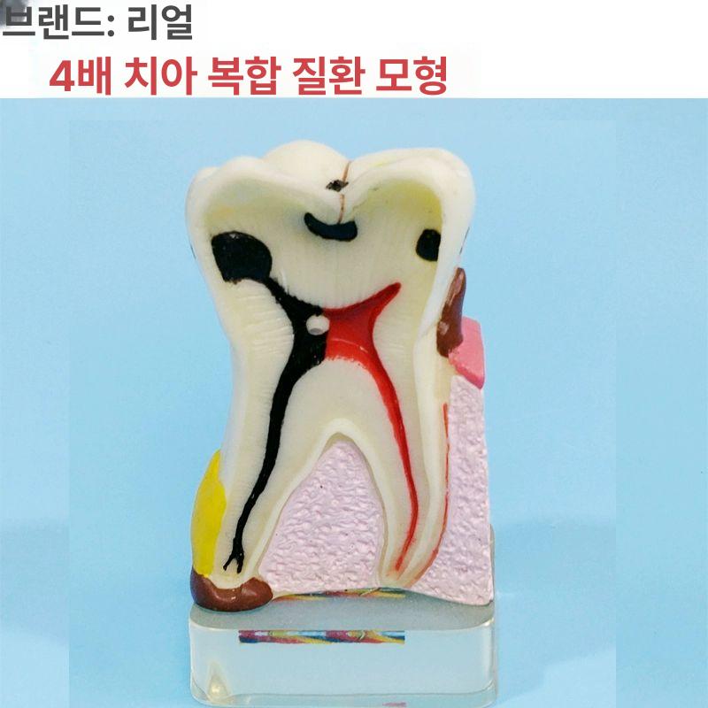치과 치아 실습 기구 교정 치열 틀니 모형 브라켓 - 상세 이미지 3