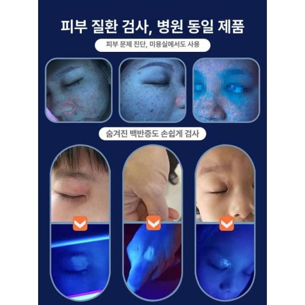 프리미엄 우드램프 피부 검사기 확대경 관찰 홈케어 테스터 검사 신제품 플러그 사용 1 1 진단+30일 - 상세 이미지 3