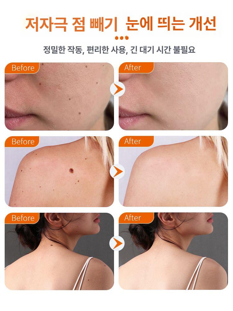 검버섯 레이저 제거기 사마귀 제거 점 빼는 기계 섬유종 피부 관리기 - 상세 이미지 4