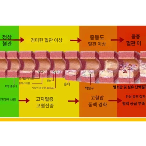 정밀 의대 교육용 혈관모형 해부학 보건 동맥 경화 혈전 단일 항목 단일 항목 - 상세 이미지 3