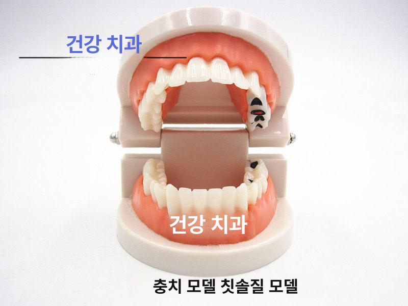 치아모형 이모형 구강 인체 디스플레이 충치 교육용 1 1 소형 - 상세 이미지 4