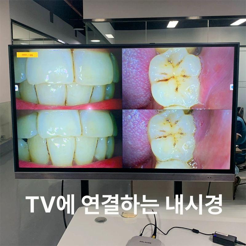 고화질 구강 내시경 치아 치과카메라 멀티미디어 무선 줄무늬 4K 전면 치과 치과 관리자 E 뷰 - 상세 이미지 4