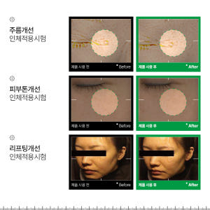 피부과 레이저 재생관리 점뺀후 여드름 인포디플러스 엑세스피316 리페어 ... 솔직 후기 | 피부 타입별 분석 - 상품 이미지 2