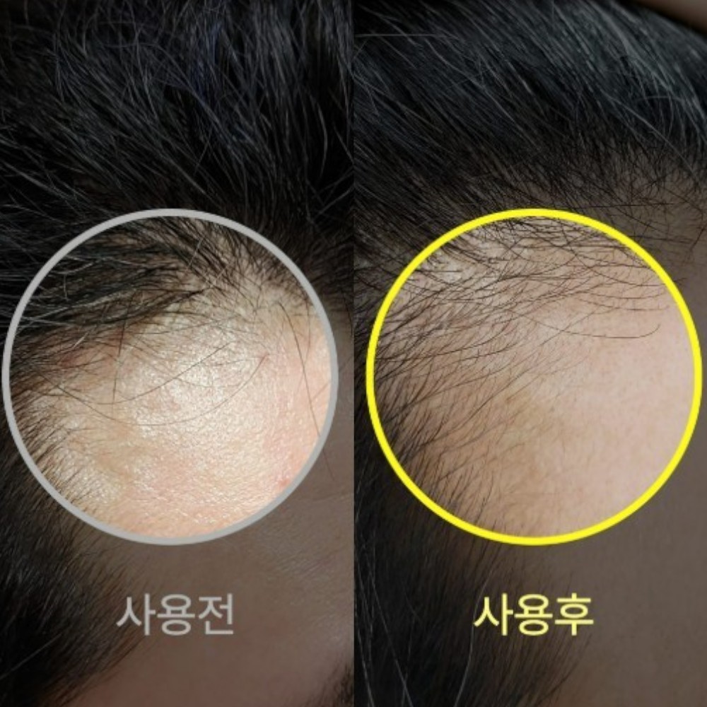 발모레아 3.3 탈모증상완화 세럼 앰플 LNP 정수리 헤어 두피 케어 10ml 1개 - 상세 이미지 4