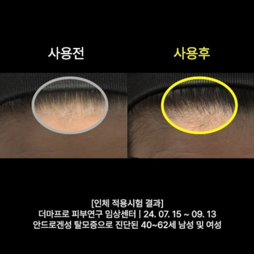 발모레아 3.3 탈모증상완화 세럼 앰플 LNP 정수리 헤어 두피 케어 10ml 1개 - 상세 이미지 5