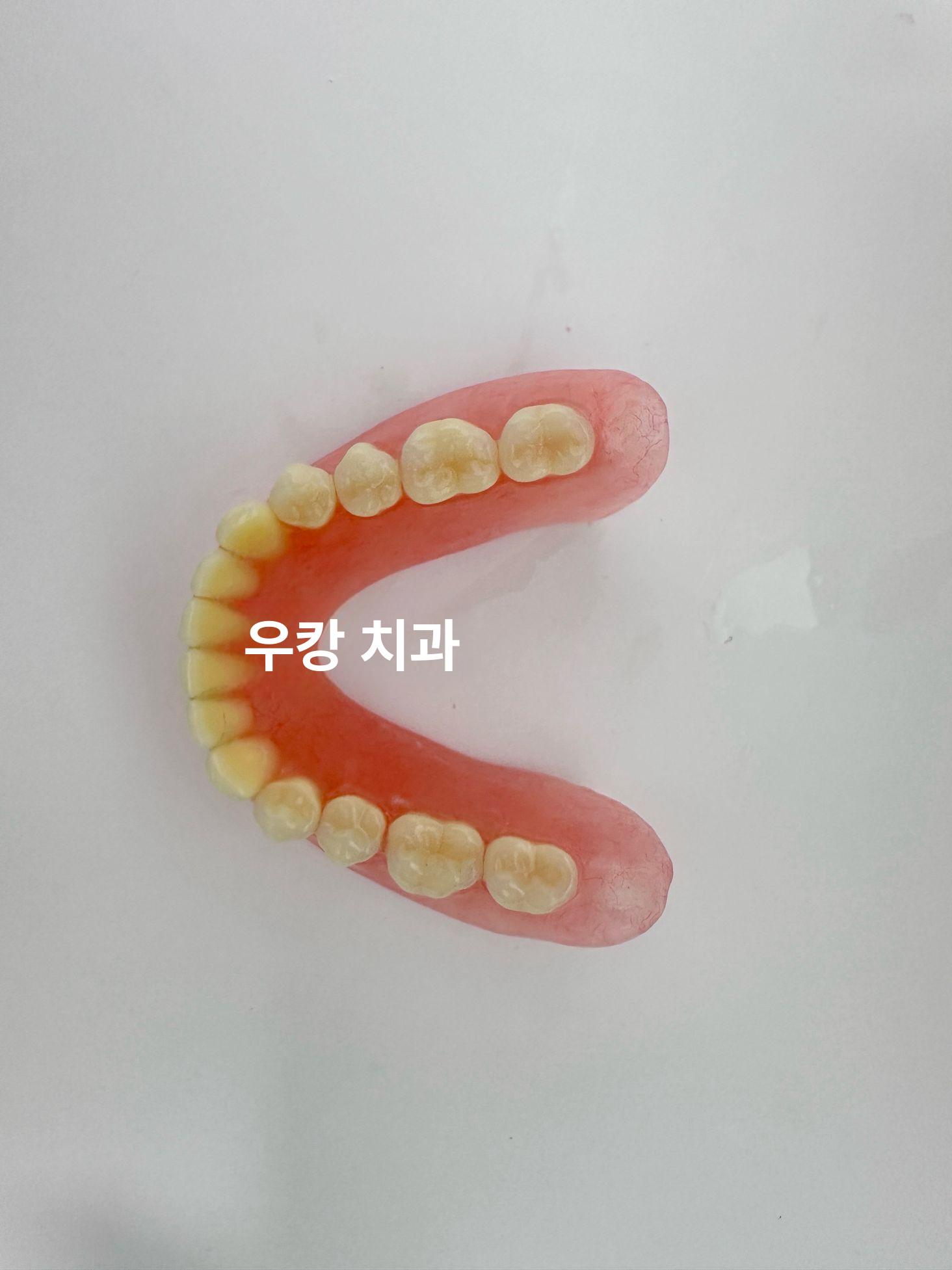 치석 치과 모형 착색 덴티폼 치아 자료 치주 상담 - 상세 이미지 3