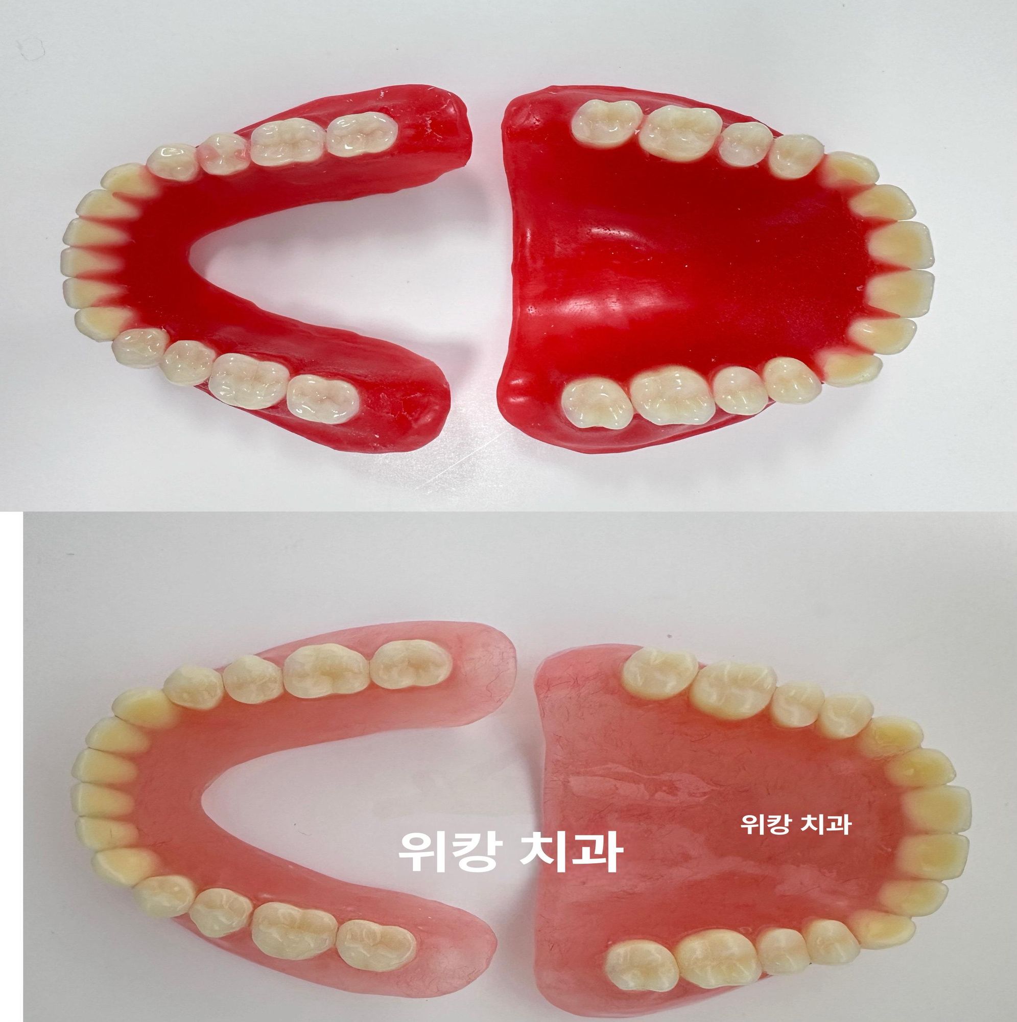 치석 치과 모형 착색 덴티폼 치아 자료 치주 상담 - 상품 이미지