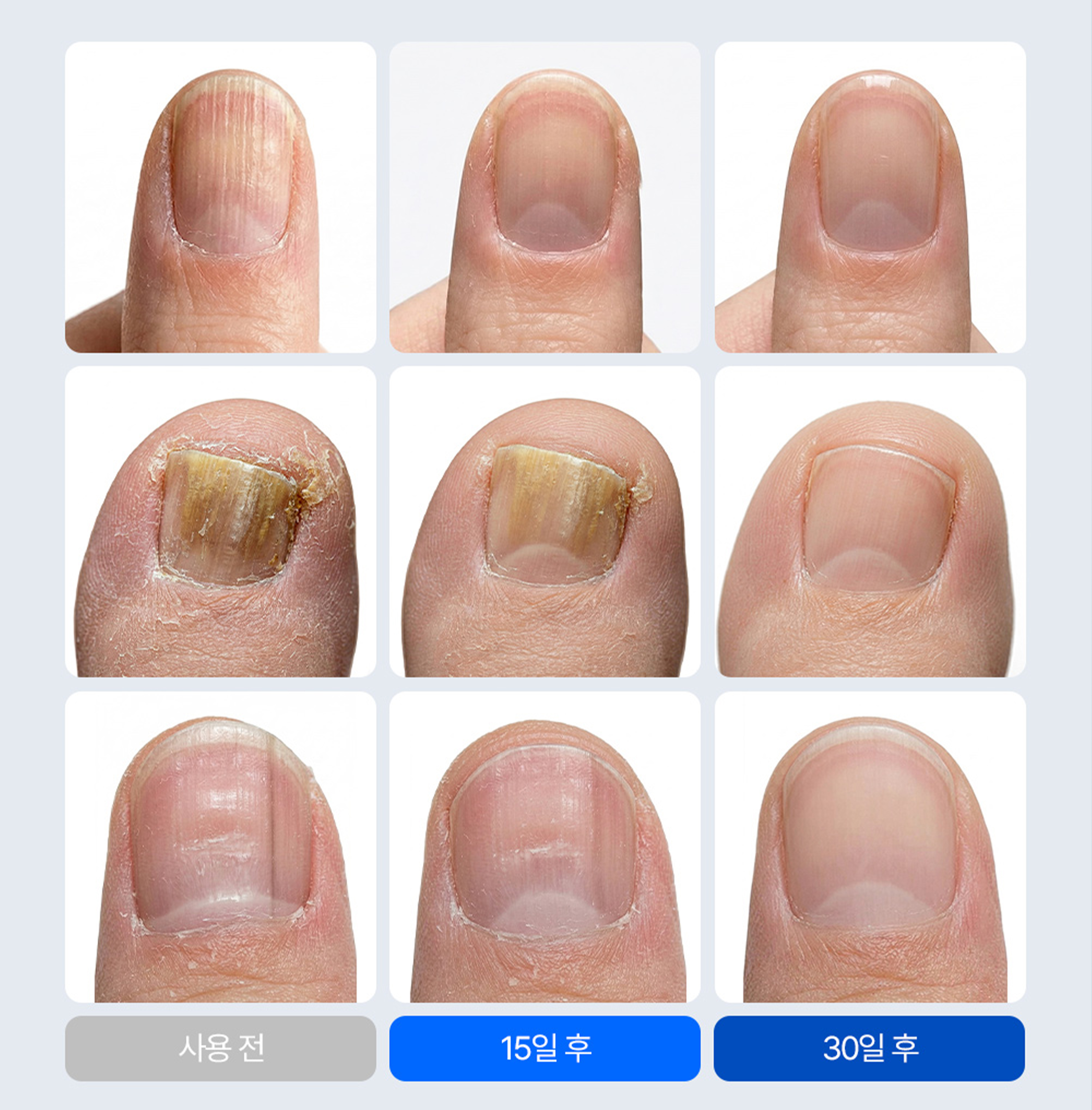 트라센 케라소프트 손톱 발톱 앰플 세로줄 울퉁불퉁 갈라짐 영양제 손발톱 연화제 상품 이미지